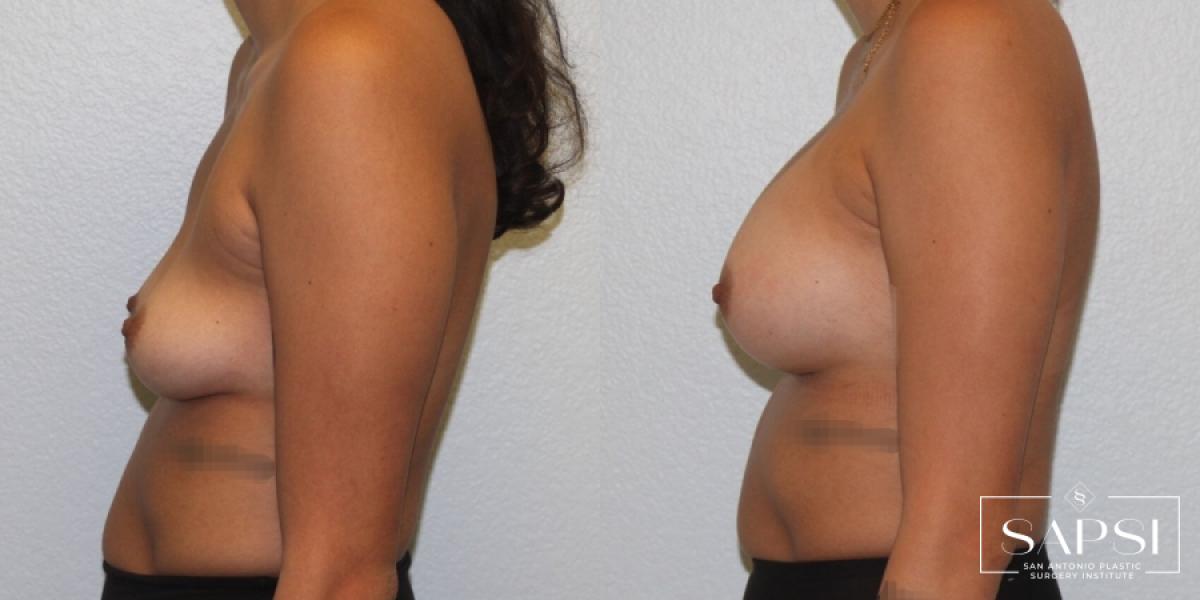 Breast Augmentation: Patient 29 - Before and After 3