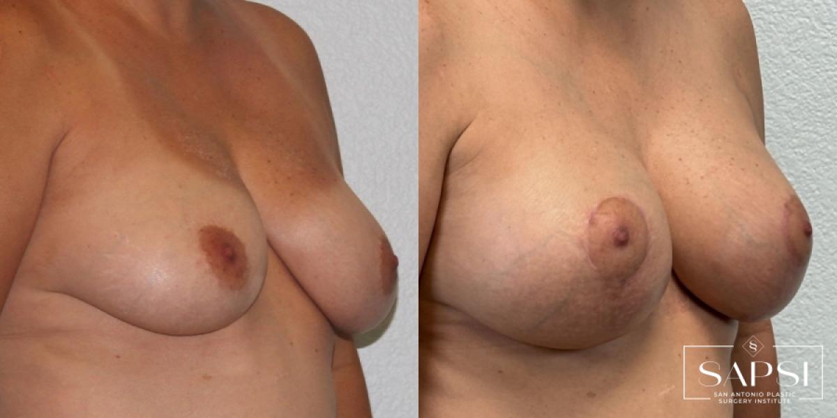 Breast Augmentation With Lift: Patient 20 - Before and After 2