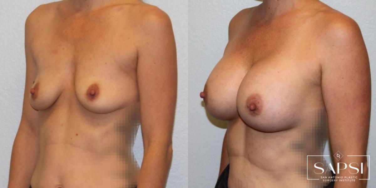 Breast Augmentation: Patient 24 - Before and After 2