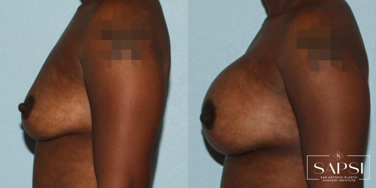 Breast Augmentation: Patient 45 - Before and After 3