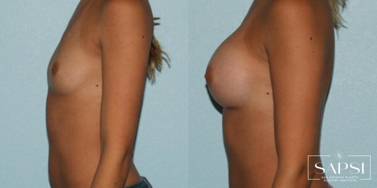 Breast Augmentation: Patient 39 - Before and After 3