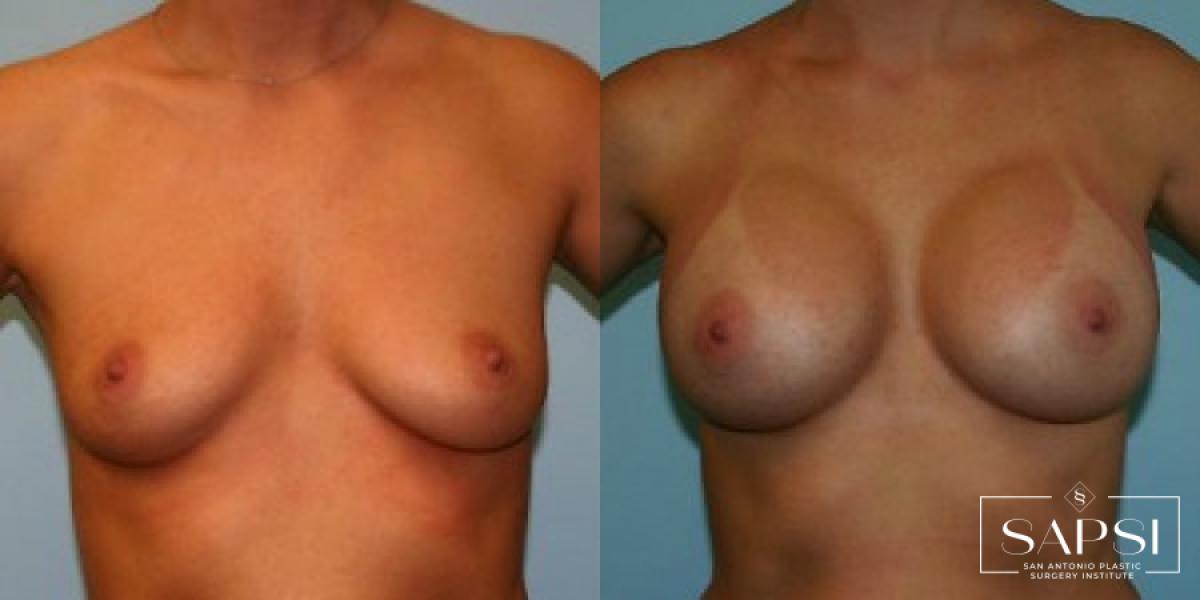 Breast Augmentation: Patient 83 - Before and After 1