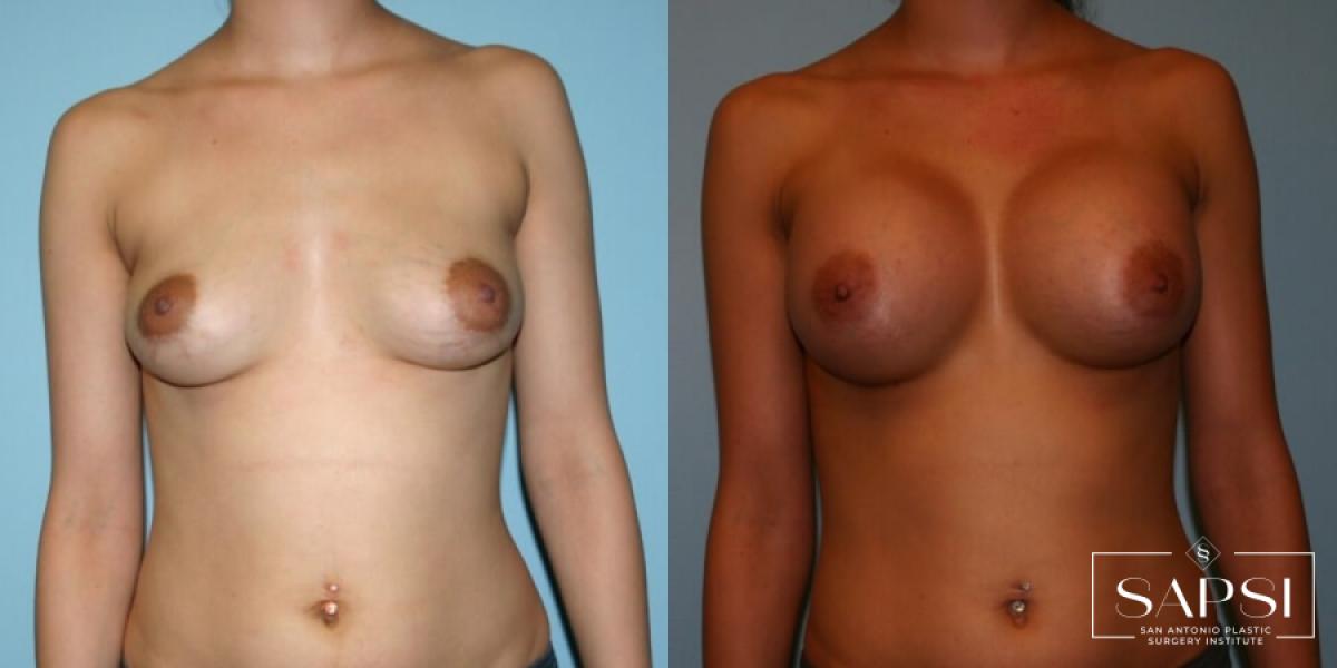 Breast Augmentation: Patient 9 - Before and After  