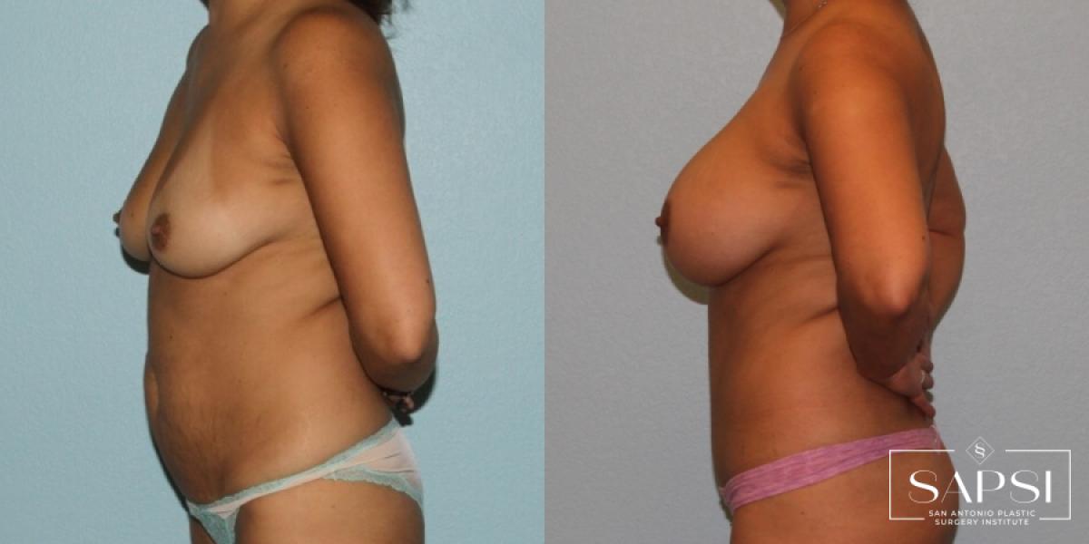 Breast Augmentation: Patient 70 - Before and After 3