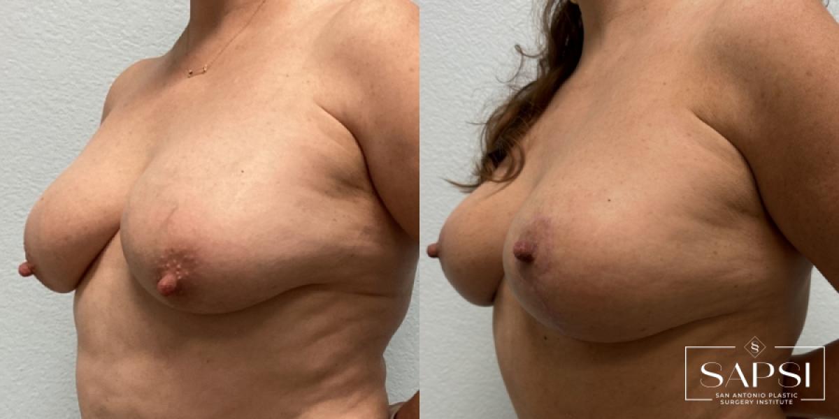 Breast Reduction: Patient 6 - Before and After 2