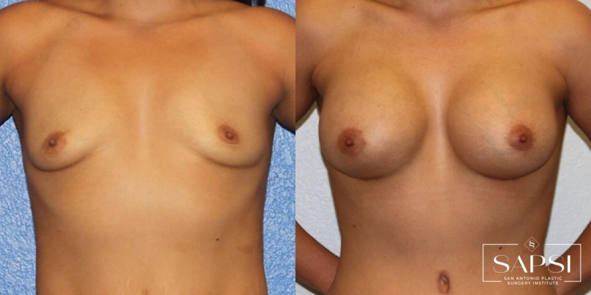 Breast Augmentation: Patient 79 - Before and After 1