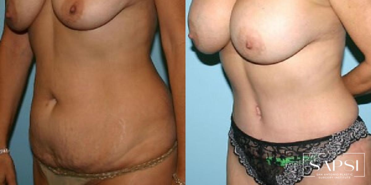 Tummy Tuck: Patient 43 - Before and After 2