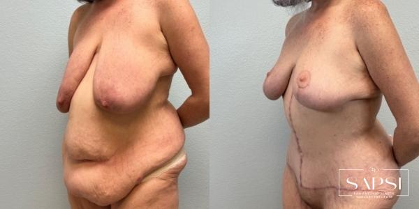 After Weight Loss: Patient 2 - Before and After 2