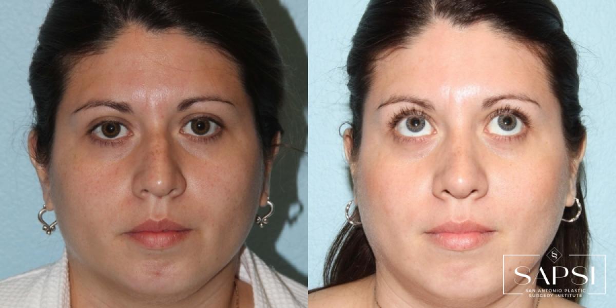 Facelift: Patient 7 - Before and After  