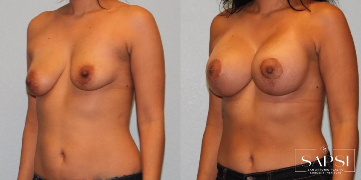 Breast Augmentation With Lift: Patient 10 - Before and After 2