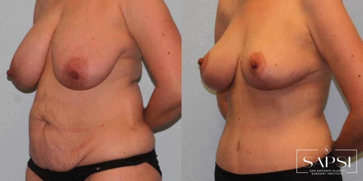 Breast Reduction: Patient 3 - Before and After 2