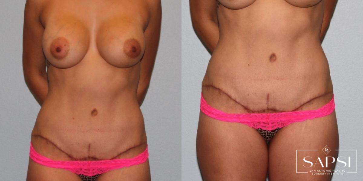 Tummy Tuck: Patient 32 - Before and After 4