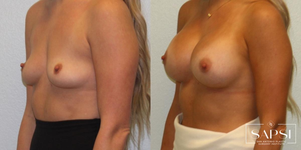 Breast Augmentation: Patient 59 - Before and After 2