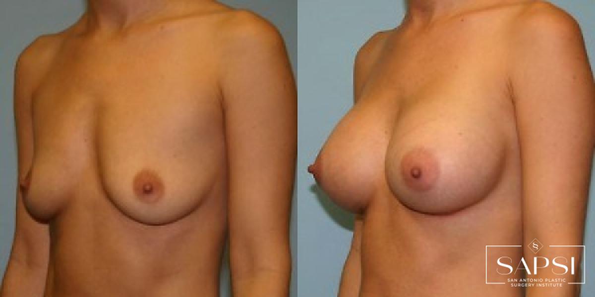 Breast Augmentation: Patient 1 - Before and After 2