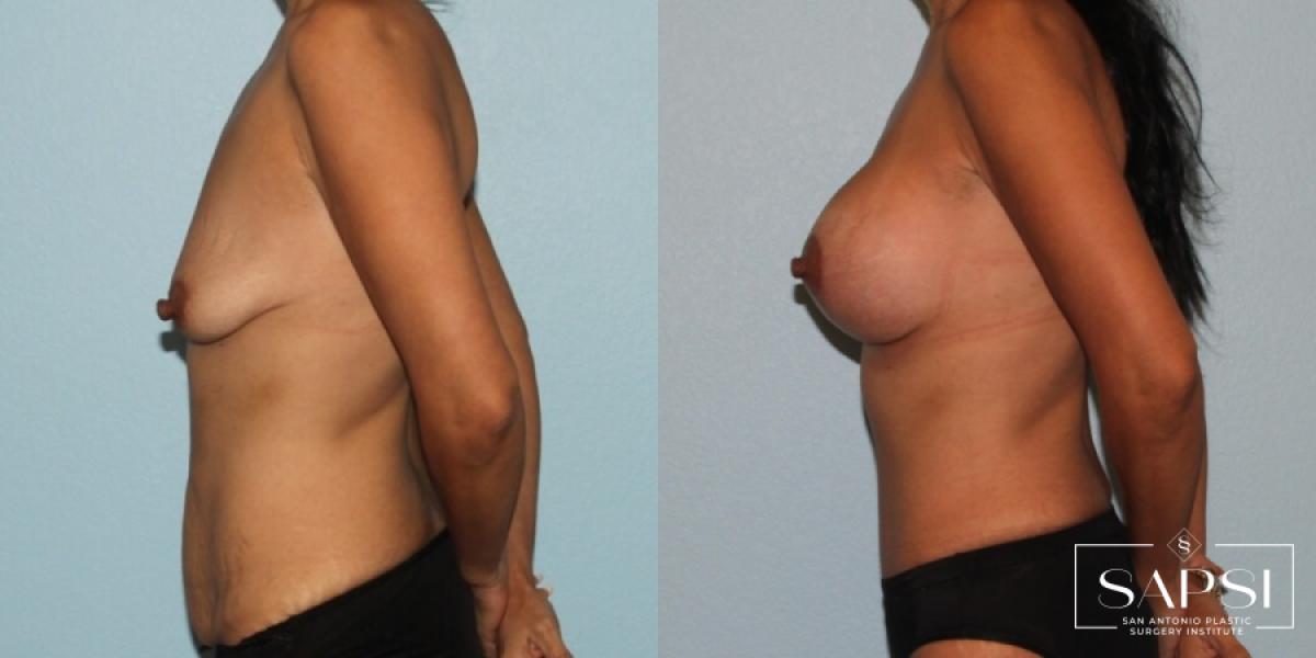 Breast Augmentation With Lift: Patient 5 - Before and After 3