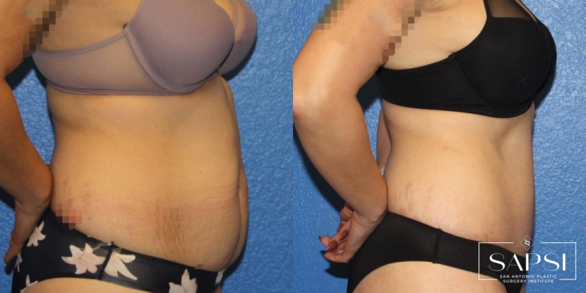 Tummy Tuck: Patient 14 - Before and After 3