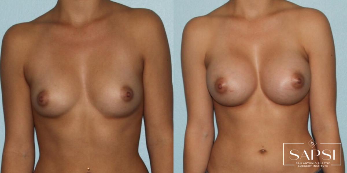 Breast Augmentation: Patient 4 - Before and After  