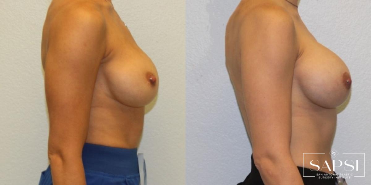 Breast Revision: Patient 1 - Before and After 3