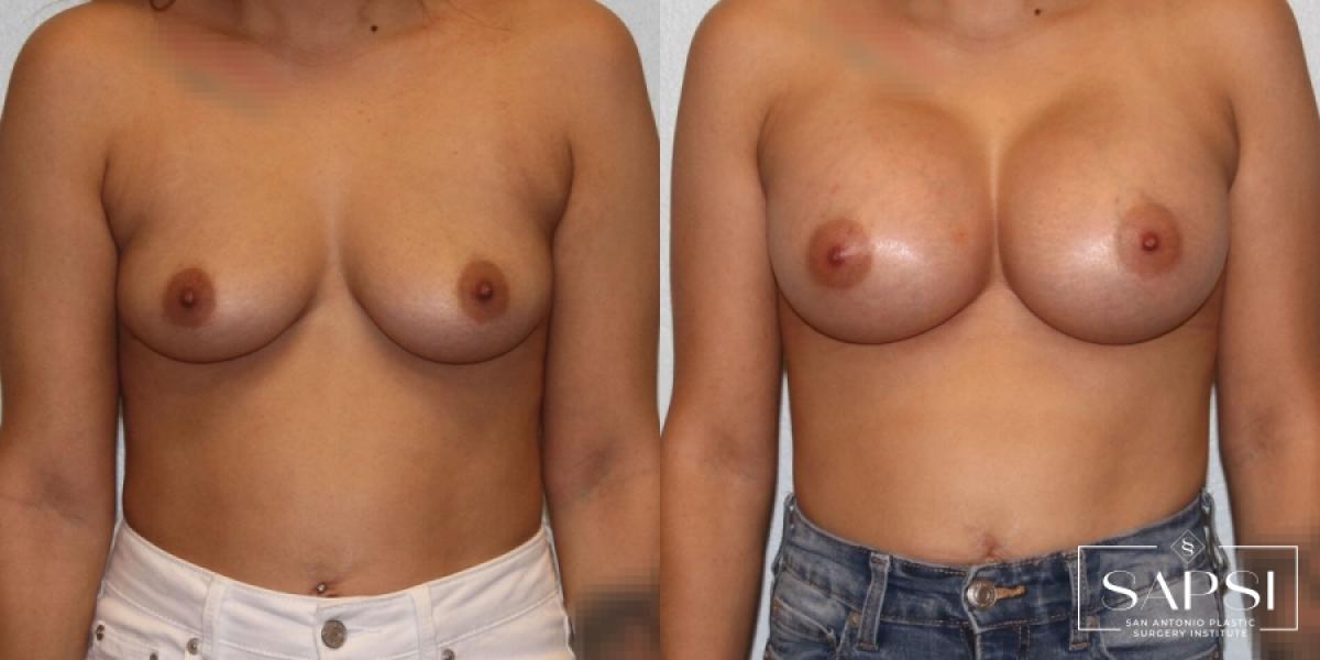 Breast Augmentation: Patient 29 - Before and After 