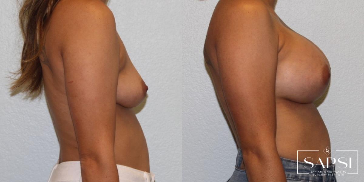 Breast Augmentation: Patient 28 - Before and After 3