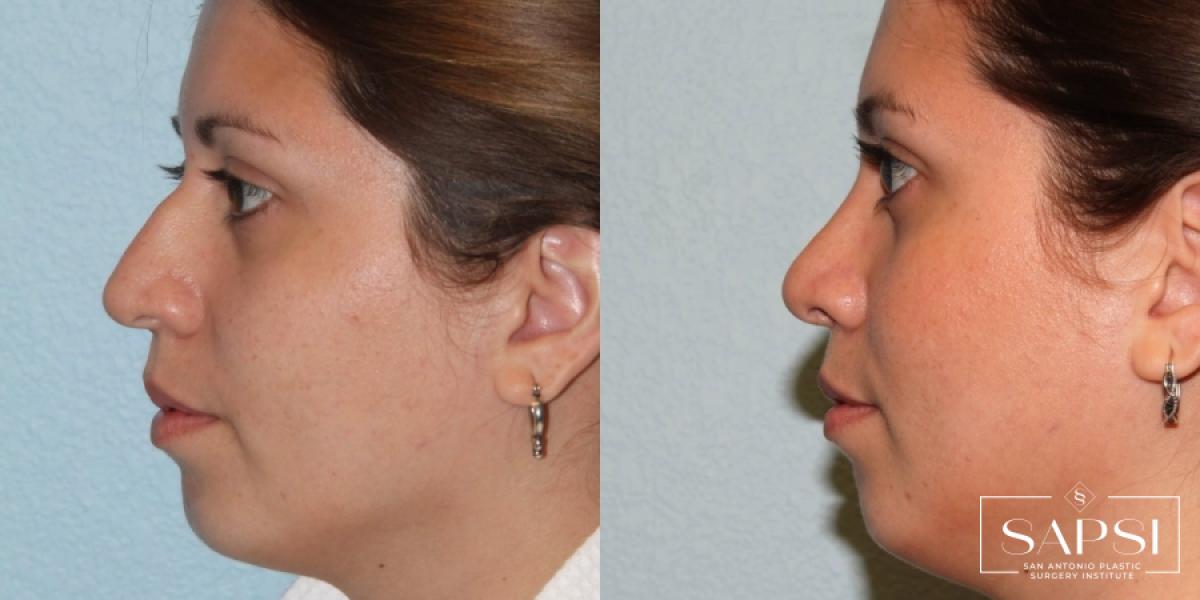 Facelift: Patient 7 - Before and After 3