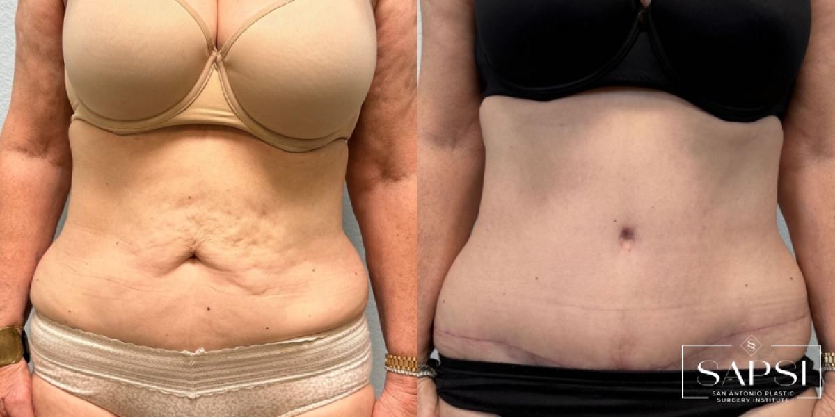 Tummy Tuck: Patient 4 - Before and After  