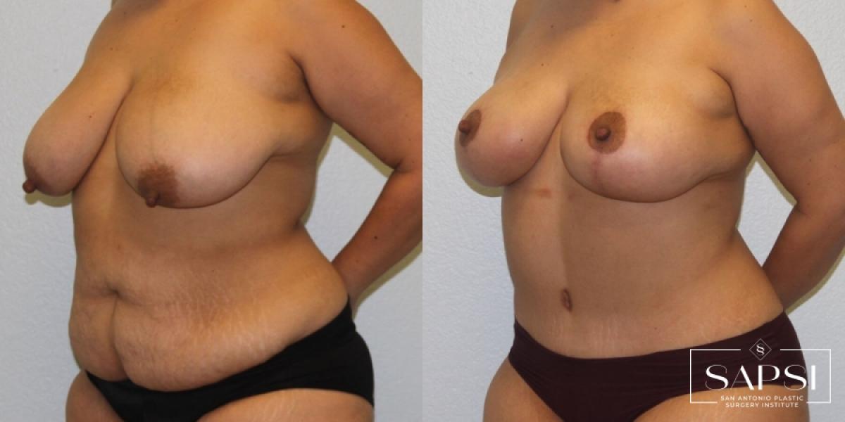 Breast Lift: Patient 2 - Before and After 2