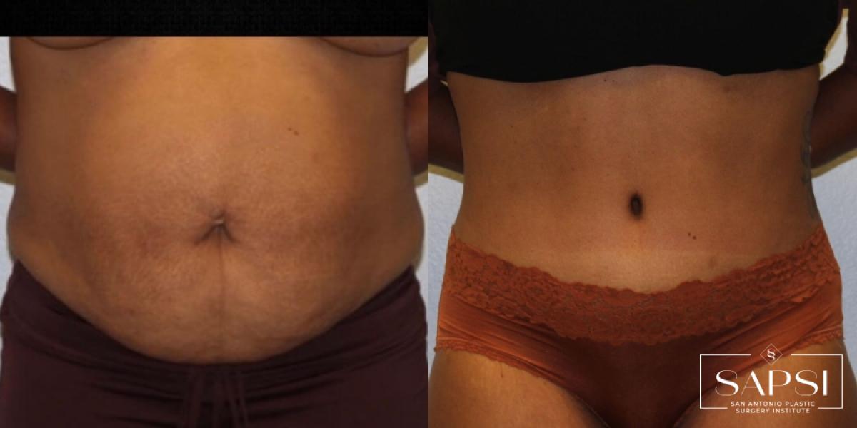 Body Contouring: Patient 3 - Before and After  