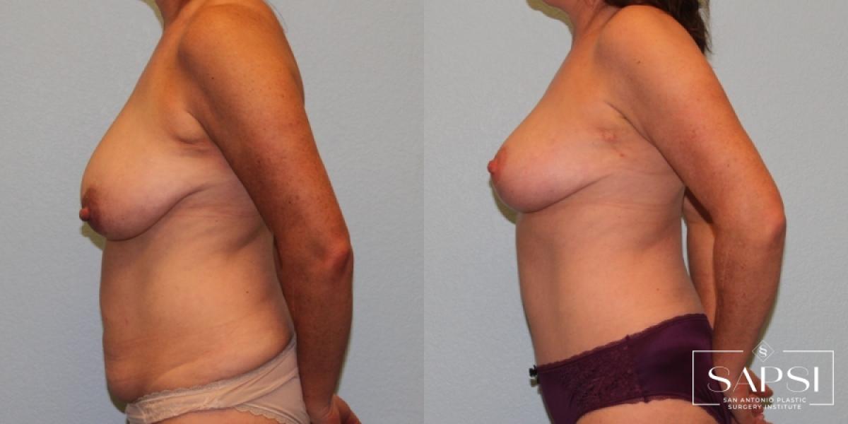 Tummy Tuck: Patient 12 - Before and After 3