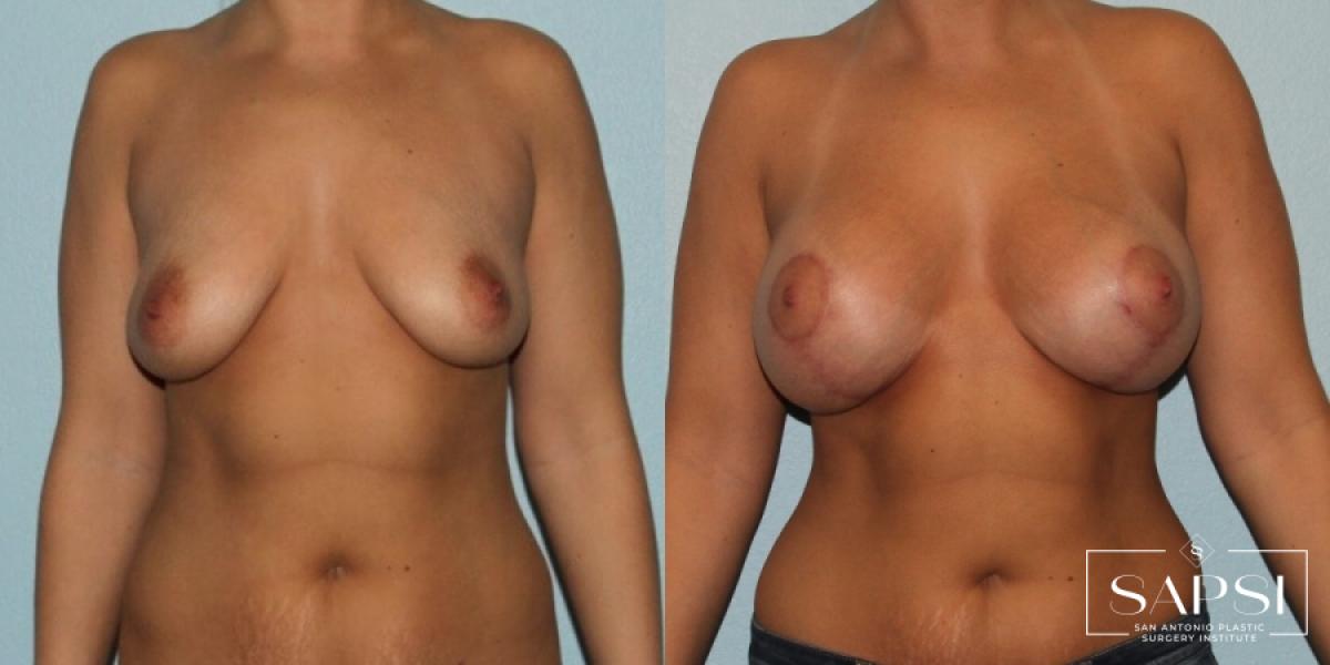 Breast Lift: Patient 16 - Before and After 