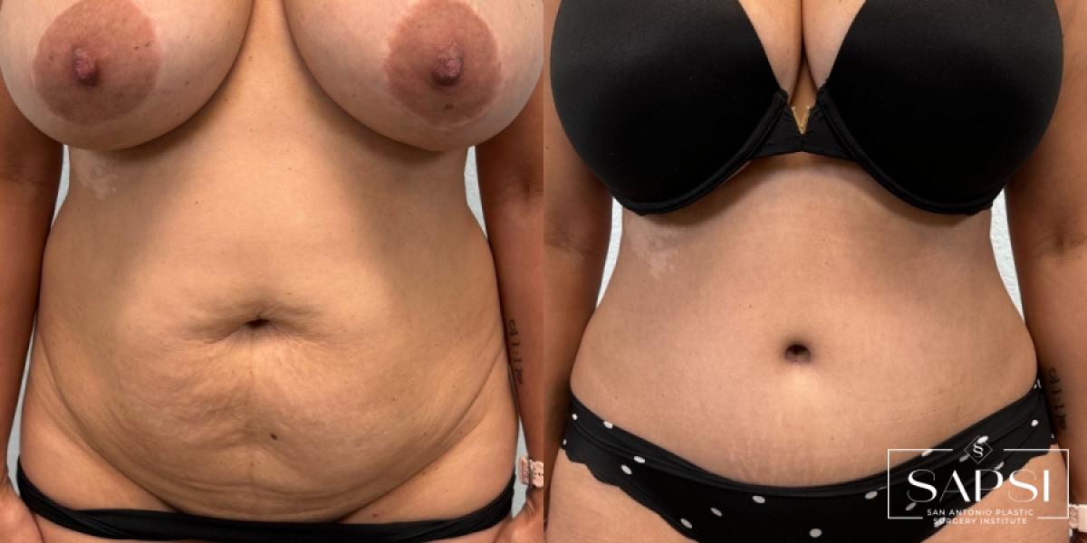 Tummy Tuck: Patient 2 - Before and After  