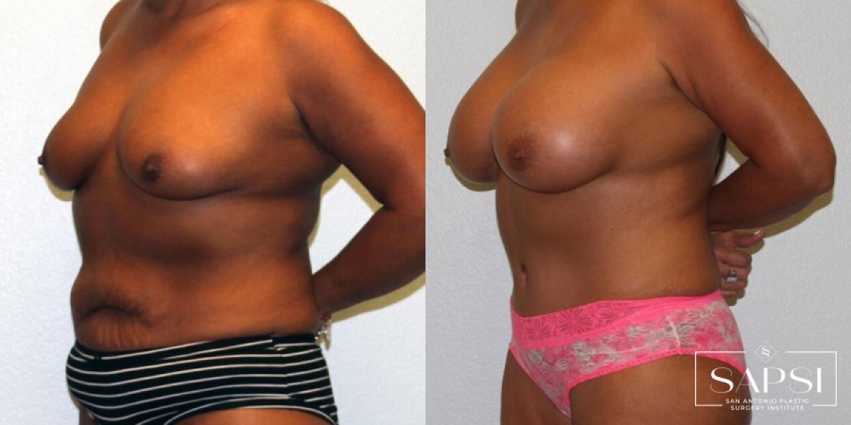 Breast Augmentation: Patient 74 - Before and After 2