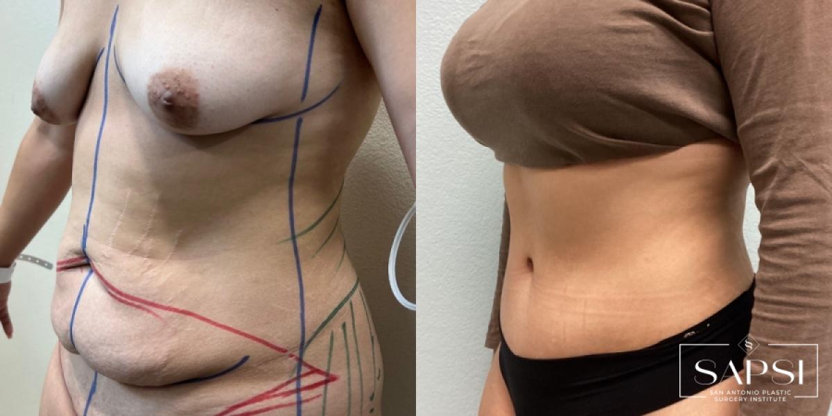 Tummy Tuck: Patient 3 - Before and After 2