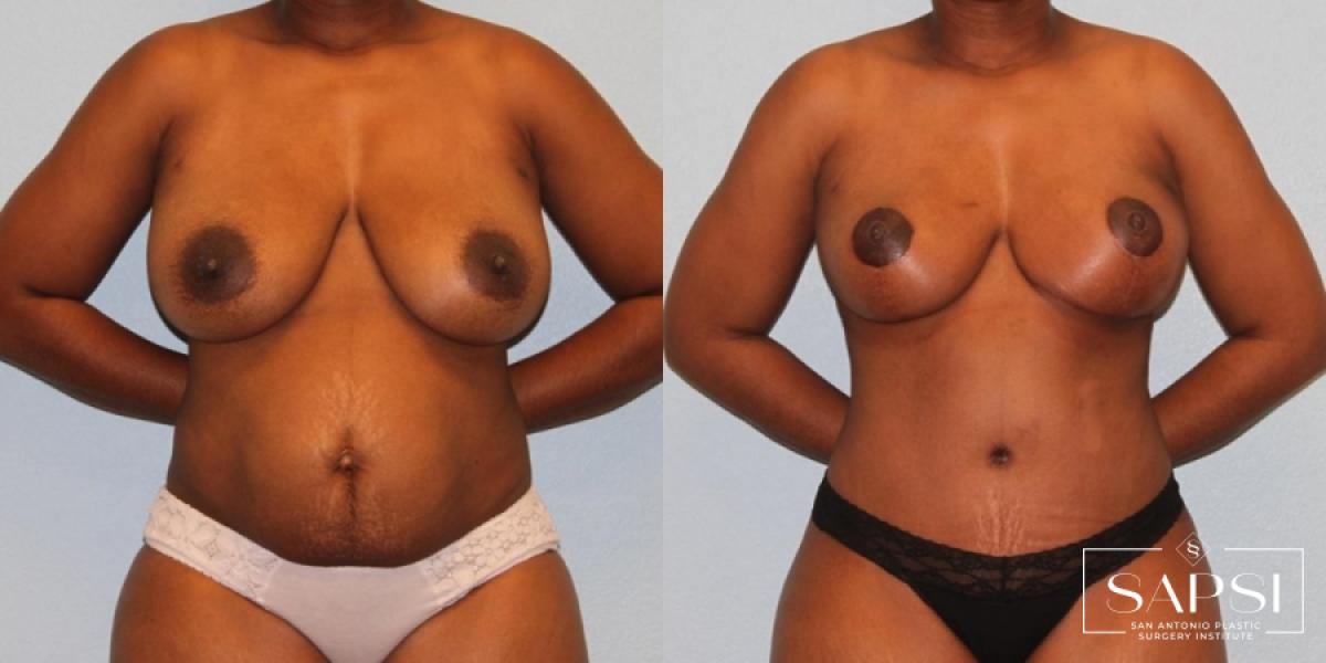 Breast Reduction: Patient 4 - Before and After  