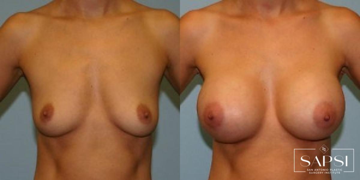 Breast Augmentation: Patient 1 - Before and After  