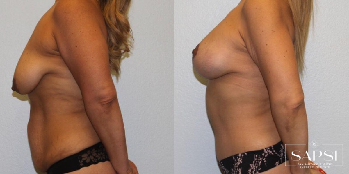 Body Contouring: Patient 8 - Before and After 3