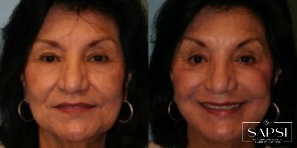 Facelift: Patient 5 - Before and After  