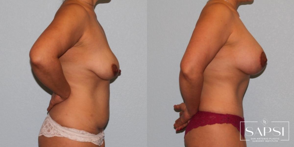 Breast Augmentation With Lift: Patient 7 - Before and After 3