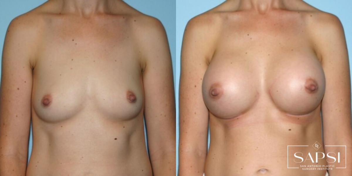 Breast Augmentation: Patient 6 - Before and After  