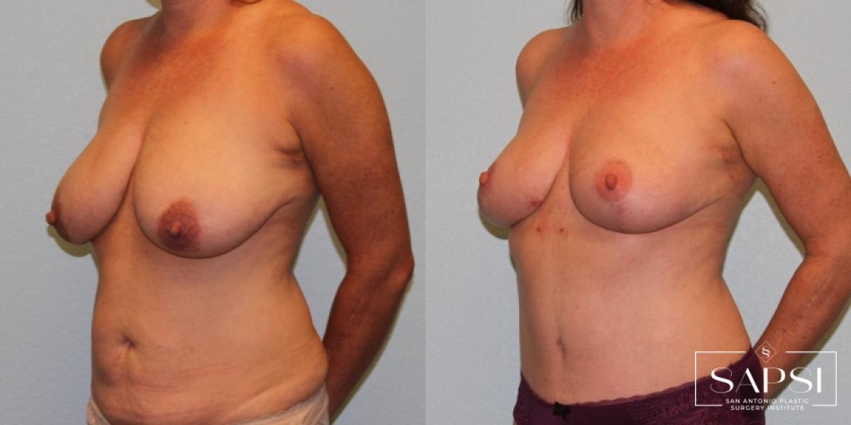 Tummy Tuck: Patient 12 - Before and After 2