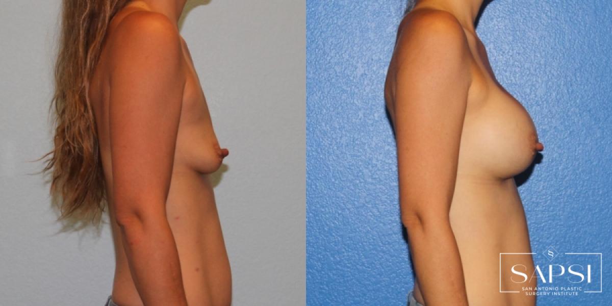 Breast Augmentation: Patient 21 - Before and After 3