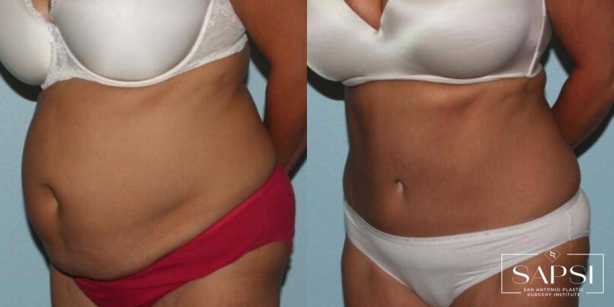 Tummy Tuck: Patient 27 - Before and After 2