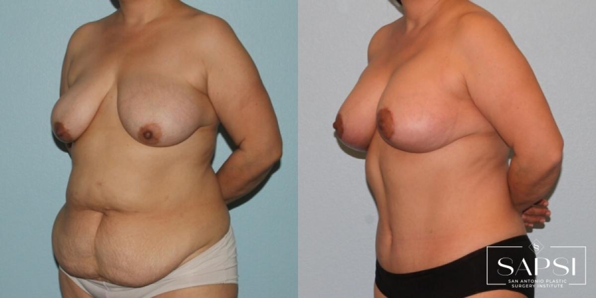 Breast Augmentation With Lift: Patient 6 - Before and After 2