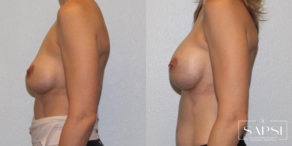 Breast Revision: Patient 6 - Before and After 3