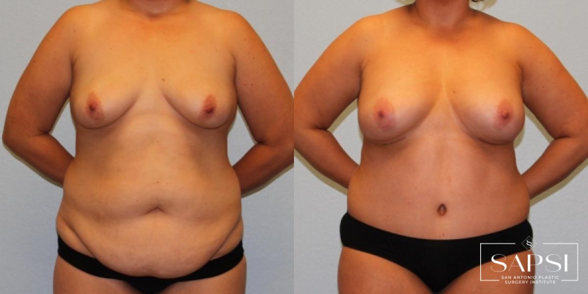 Tummy Tuck: Patient 34 - Before and After 1