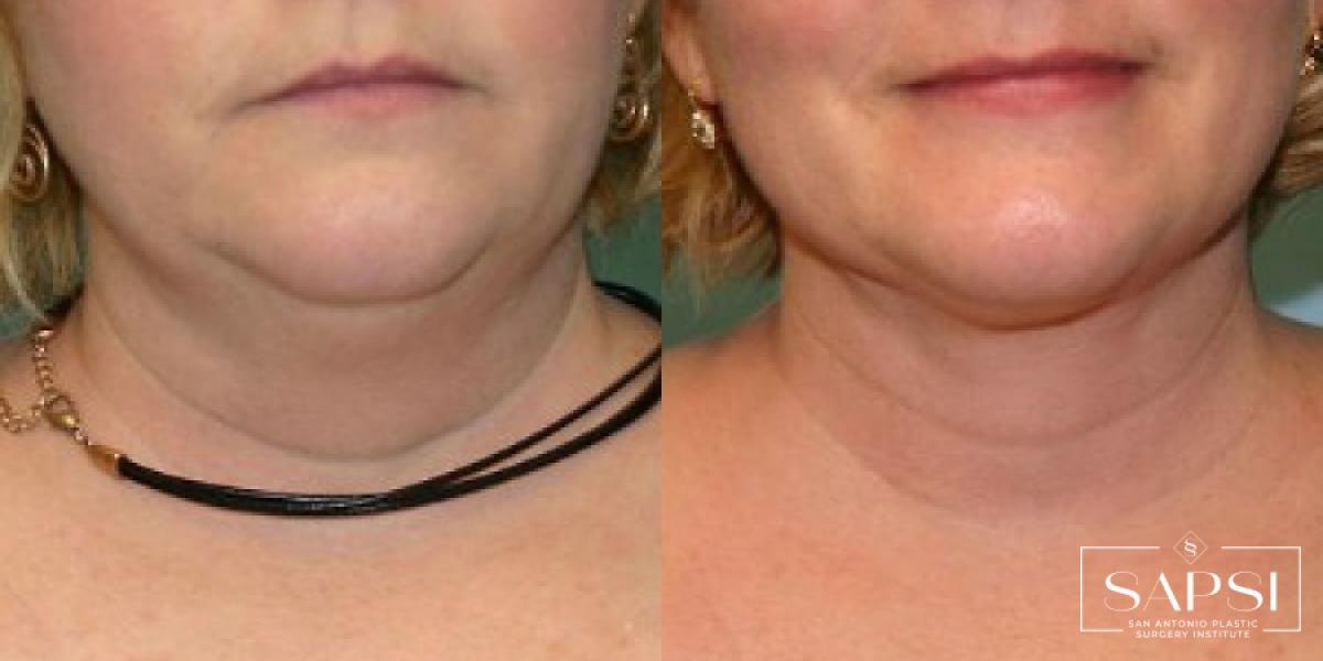 Liposuction: Patient 5 - Before and After  