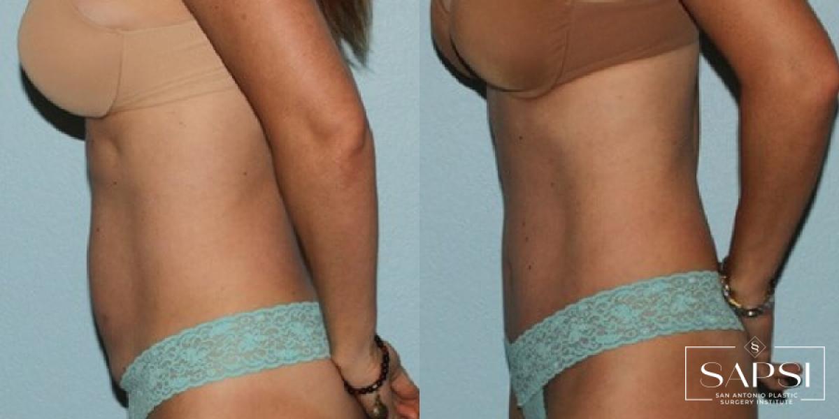 Tummy Tuck: Patient 29 - Before and After 3