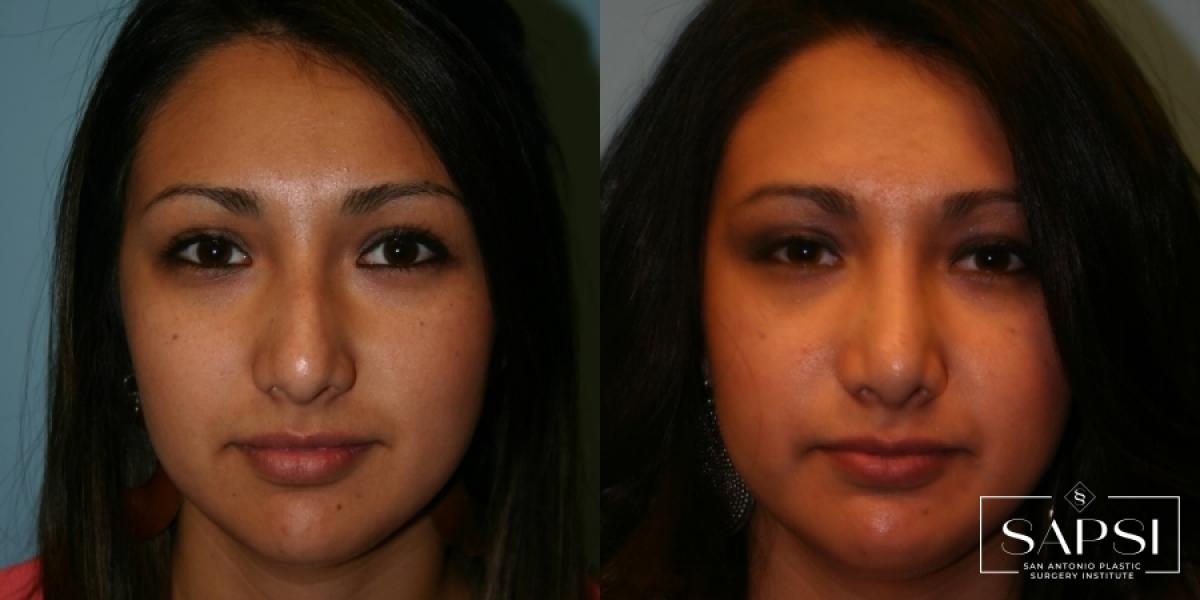 Facelift: Patient 3 - Before and After 2