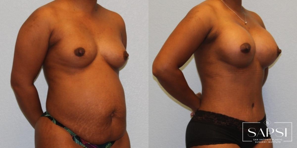 Tummy Tuck: Patient 35 - Before and After 2