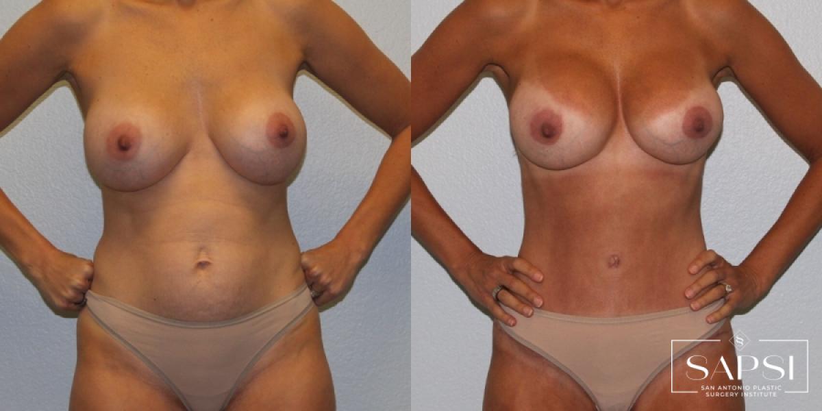 Breast Revision: Patient 5 - Before and After  